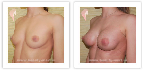пластические операции на груди